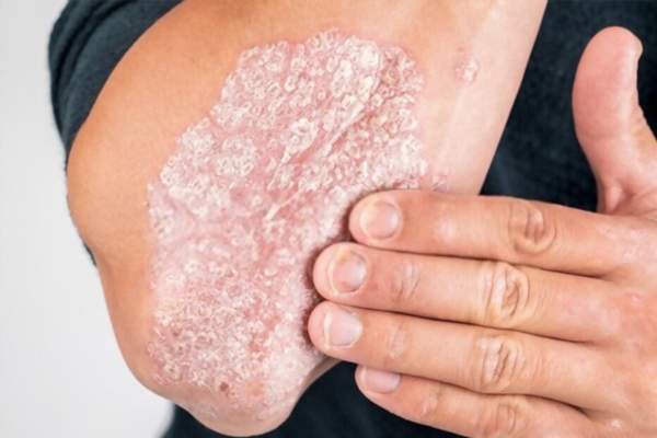 Skin Diseases treatment dubai